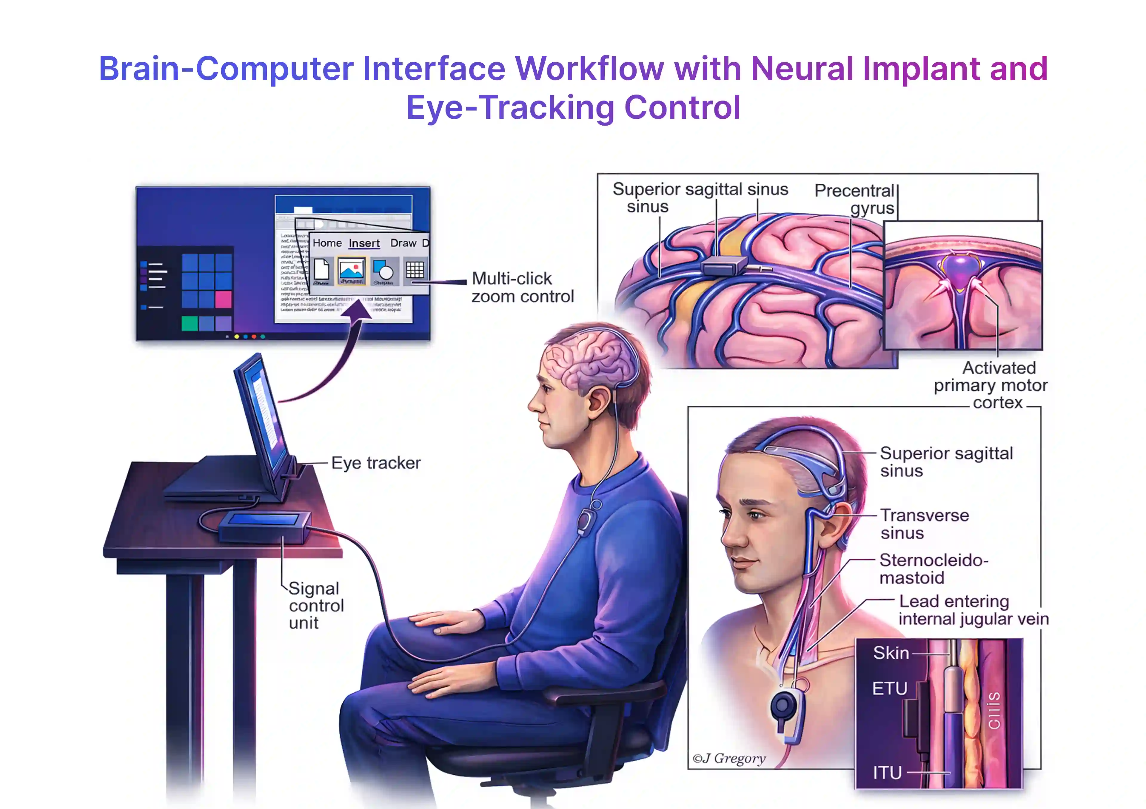 Workflow graphic showing how a neural implant and eye-tracking system support computer control