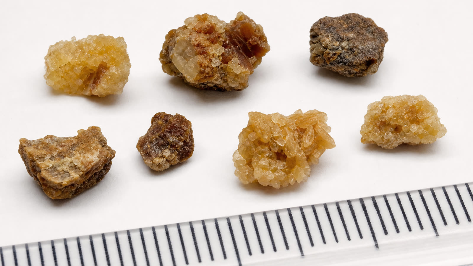 Macro close-up of several real kidney stones of different colors and textures next to a ruler for scale