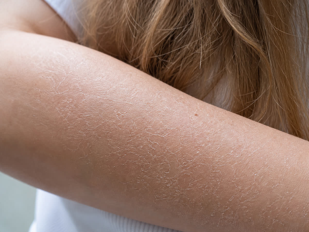 Close-up of dry flaky skin on a forearm and dull brittle hair illustrating essential fatty acid deficiency